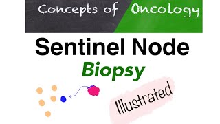 Sentinel node biopsy  A simple way to Understand [upl. by Harlene]