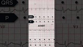 AVNRT ECG Retrograde p waves [upl. by Yanel]