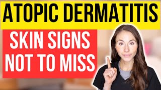 Dont Miss These 15 Signs Of Atopic Dermatitis [upl. by Aremihc]