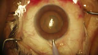 Surgery Phacoemulsification Dr Stephen Lane [upl. by Giardap]