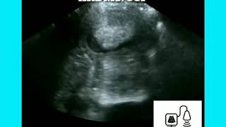 Fibroma Tumor Ultrasound [upl. by Namaj635]