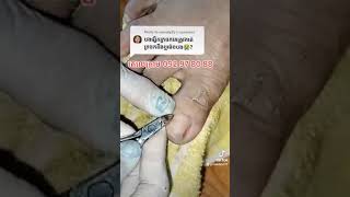 Double ingrown toenail treatment nail​​​ asmr fyp ear shorts viral wax [upl. by Towne180]