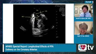 Heart Rhythm TV Update APHRS Special Report  Longitudinal Effects of PFA Delivery [upl. by Onileva]