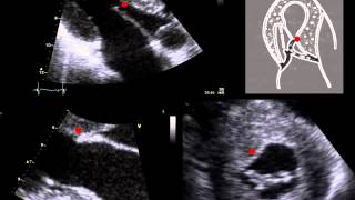 SYSTOLIC ANTERIOR MOTION OF THE MITRAL VALVE [upl. by Barbabra762]