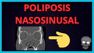 POLIPOSIS NASOSINUSAL Hallazgos👉RADIOLÓGICOS [upl. by Aisya]