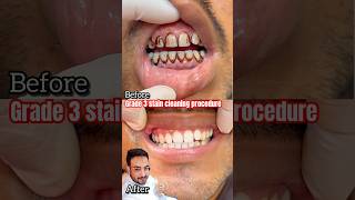 Cheapest teeth whitening procedure live😍 viralvideo dentist [upl. by Nayd]