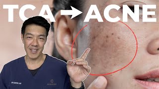 TCA for Ice pick scars  Dr Davin Lim [upl. by Yelyab]