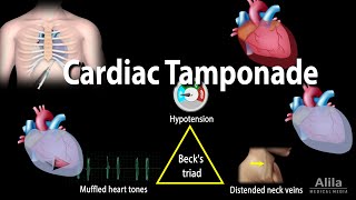 Cardiac Tamponade Pathophysiology Etiology Symptoms Diagnosis and Management Animation [upl. by Sarina]