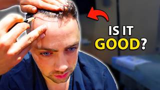 I Finally Got a Hair Transplant  Hair Surgeon Reacts [upl. by Ereveneug]