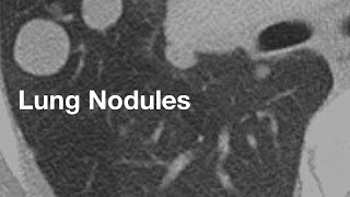 Lung Nodules basics for patients [upl. by Yoreel645]