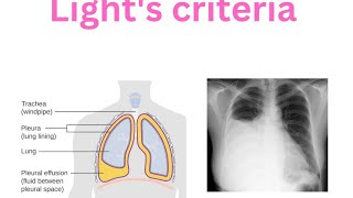 Pleura  Pleural effusion  Lights criteria  Transudate  Exudate Empyema [upl. by Shields]