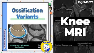 Fig 5B27 Types of Ossification Variants of the Knee [upl. by Ahsenet]