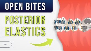 Anterior OPEN BITE  Posterior Elastics  Orthodontic Treatment [upl. by Daisi690]