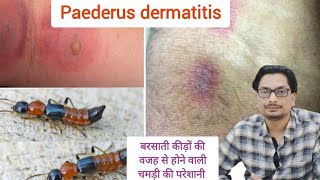 Paederus dermatitis  Blister beetle dermatitis  बरसाती कीड़ों की वजह से होने वाली चमड़ी की परेशानी [upl. by Kolb]