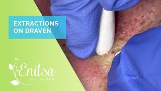 Blackhead Extractions With Draven [upl. by Godwin]