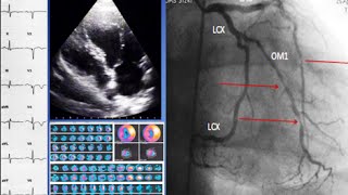 A case of ischemic cardiomyopathy ECG echo SPECT coronary angiography and treatment [upl. by Haeli194]