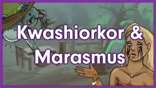 Kwashiorkor vs Marasmus  Nutrition Mnemonic [upl. by Hamid679]