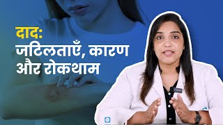 दाद जटिलताएँ कारण और रोकथाम [upl. by Lombardi368]