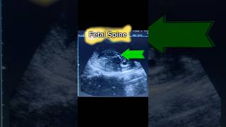 How to Obs Ultrasound Pregnancy Scan shorts [upl. by Fabi542]