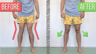 How to Fix Knock Knees Valgus Knees [upl. by Hedvig]