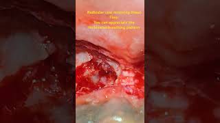 Radicular cyst of anterior maxilla post enucleationappreciate inferior turbinates breathing cysts [upl. by Valentijn64]