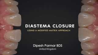 Diastema Closure Perfection  Using a modified matrix approach [upl. by Orferd]