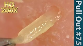 75 Pull Out Blackheads Close up 200X  Blackheads Removal [upl. by Ednutey]