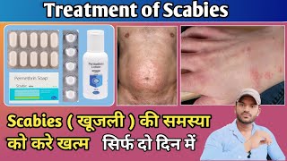 Treatment of scabiesखाज खुजली की समस्या को करें दो दिन के खत्म [upl. by Eus]