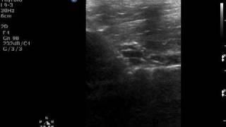 FAST ABCDE A1 Airway Obstruction Cricothyroidotomy Ultrasound Life Support Winfocus [upl. by Kumar683]