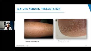 CeraVe SkinChat Mature Xerosis Patients Considerations and Tips for Epidermal Barrier Maintenance [upl. by Yokoyama991]