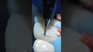 Mastering direct restoration of anterior teeth DentalEducation AnteriorRestoration [upl. by Nereus872]