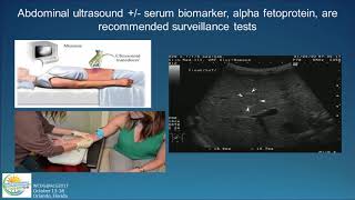 Diagnosis and Screening of Hepatocellular Carcinoma HCC [upl. by Charil]