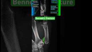 Thumb Fracture  Bennett’s fracture shorts radiology xray trauma [upl. by Edualc]