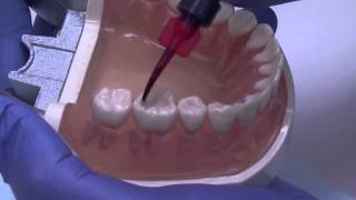 Dental Sealants  Moms Everyday May 2013 [upl. by Ahsitneuq]