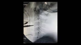 CERVICAL SPINAL CORD INJURY ANTERIOR CERVICAL CORPECTOMY AND PLATING [upl. by Jorgan996]