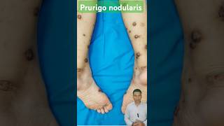 PRURIGO NODULARIS शरीर पर खुजली और गांठें  dryskin itching nodules shortsfeed ytshorts short [upl. by Esille506]