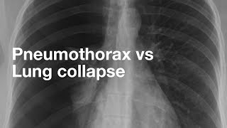 Pneumothorax vs Lung Collapse [upl. by Solram]