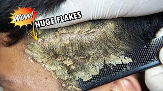 Huge Dandruff Flakes Removing and Picking 635 [upl. by Goulette189]