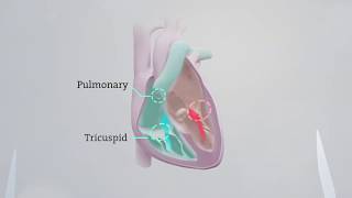 What is Aortic Stenosis Animation [upl. by Htrag308]