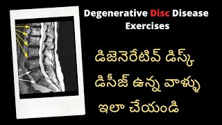 Disc Degeneration Disease DDD Treatment for Degenerative Disc Disease Lumbar Disc L4L5 L5S1 [upl. by Ardekan]