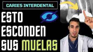 Te SORPRENDERÁ lo que ESCONDEN estas muelas  CARIES INTERDENTAL O INTERPROXIMALES [upl. by Toombs]