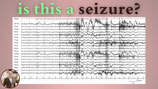 Photomyoclonic Response on EEG Not a Seizure Here’s Why [upl. by Knox713]