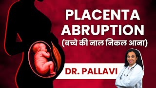 Placenta Abruption Causes Symptoms Diagnosis amp Treatment  Explained in Hindi  Abruptio Placentae [upl. by Annaor]