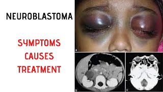 NEUROBLASTOMA Symptoms Signs Causes Treatment [upl. by Dovev]