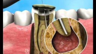 Treatment of Apical Periodontitis  a new approach [upl. by Rednirah]