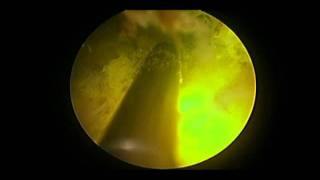 Greenlight Laser Surgery Miami Urology BPH Specialist David Robbins MD Urologist [upl. by Okia]