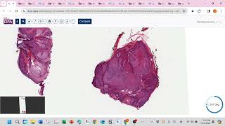 Cellular neurothekeoma and follicular neoplasm neurofibroma [upl. by Akkinahs346]