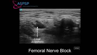 Ultrasound Guided Femoral Nerve Block In a Patient With Vascular Stent [upl. by Balbinder]