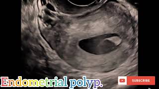 Endometrial polyp in ultrasound views [upl. by Llertnod503]