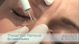 Thread Vein Removal on Face by Laser  London [upl. by Ellerad]